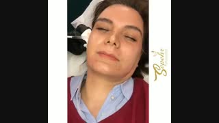 فیلم واقعی از یک جلسه جوانسازی صورت