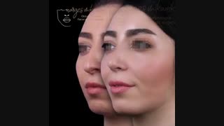 فیلم تغییرات بعد عمل بینی