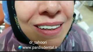 ایمپلنت دندانهای فک بالا-مرکز فوق تخصصی ایمپلنت پردیس