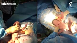 سزارین دوقلوها به روش اسپاینال