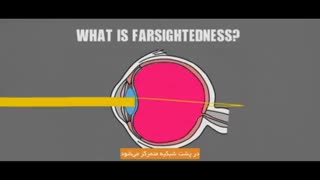 دوربینی به چه علت اتفاق می افتد؟