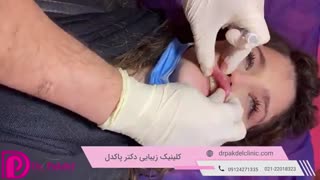 تزریق ژل لب | قیمت و معرفی انواع ژل
