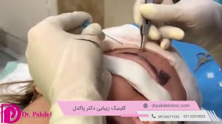 کاشت ابرو طبیعی چیست و چگونه انجام می شود؟