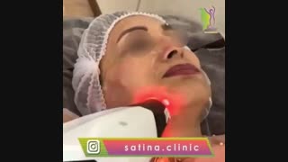 ویدئو واقعی جوانسازی با دستگاه RF کلینیک زیبایی