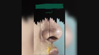 میکرودرم آبریژن چیست؟؟ عصب‌کشی