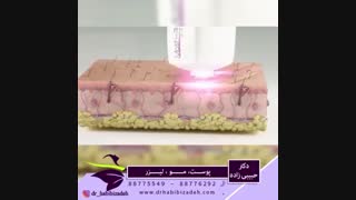 فیلم انیمیشن لیزر موهای زائد