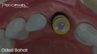 ایمپلنت فک بالا و مسائل آن