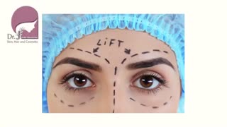 لیفت و بالا کشیدن ابرو