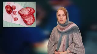 فیبروم رحمی