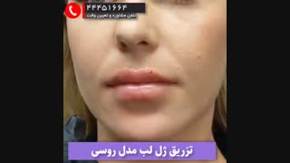 ژل لب روسی با متد کدینگ