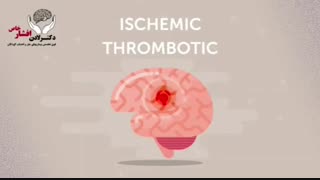 فیلم چگونگی بروز سکته مغزی در کودکان