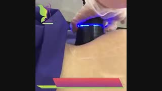 ویدئو واقعی لاغری با دستگاه کویتیشن