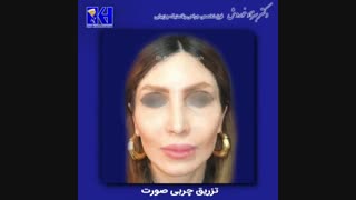 تزریق چربی صورت