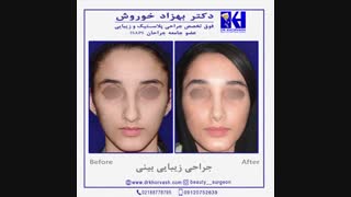 جراحی زیبایی بینی