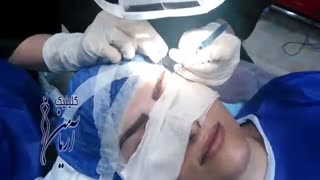 کاشت ابرو در کلینیک تخصصی آریامن