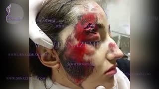 عمل جراحی ترمیمی و پلاستیک در دختر جوان پس از تصادف شدید