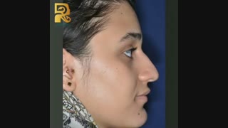 جراحی بینی