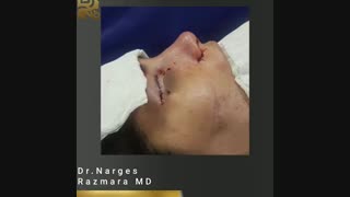 جراحی همزمان رینوپلاستی و بلفاروپلاستی