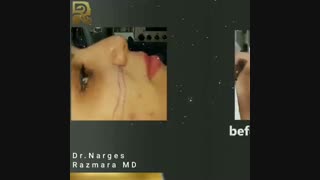 قبل و بلافاصله بعد از پایان جراحی بینی