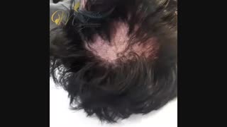 بازگشت موها و بهبودی ریزش مو بعد از چهار سال