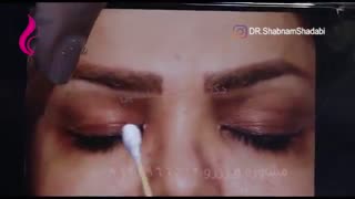 بلفاروپلاستی پلک بالا