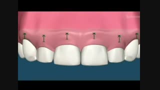 اصلاح فرم لثه برای اصلاح طرح لبخند و ایجاد لبخندی زیباتر | دکتر احسان مهریزی