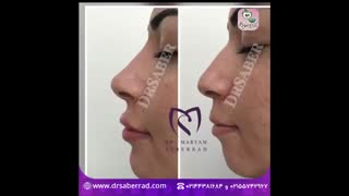 تزریق فیلربینی ، لب و چانه