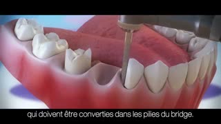 انیمیشن نحوه بریج دندان-مرکز فوق تخصصی پردیس