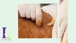 فیلم اندولیفت شکم