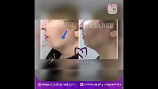 هایفو و اراف ترماژ