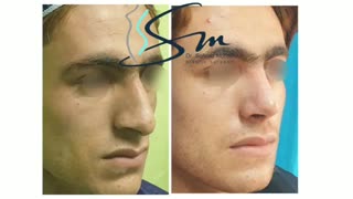 فیلم جراحی بینی مردانه