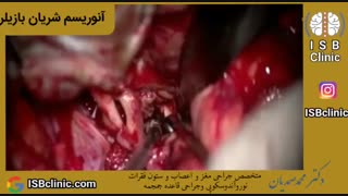 آنوریسم مغزی (کلاف عروقی مغز)