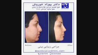 جراحی زیبایی بینی