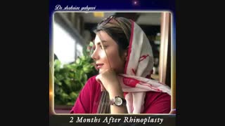دو ماه بعد از جراحی بینی