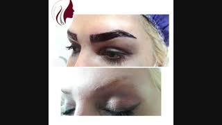 فیلم واقعی کاشت ابرو