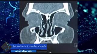 جراحی کیسه اشکی