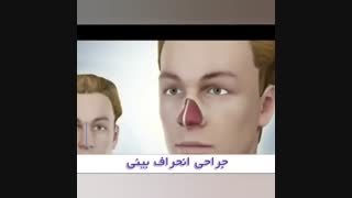 جراحی انحراف بینی