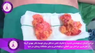 جراحی اصلاح ژنیکوماستی شدید