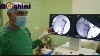 فیلم واقعی و بدون سانسور جراحی شکستگی چند قطعه ای استخوان بازو