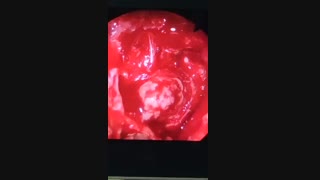 جراحی هیپوفیز آکرومگالی