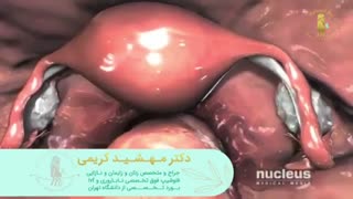 فیلم  واقعی جراحی لاپاراسکوپی