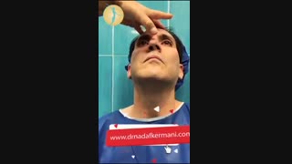 لیفت ابرو آقایان