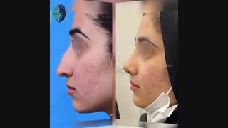 3 هفته بعد از جراحی بینی استخوانی | دکتر باستانی نژاد | جراح بینی تهران