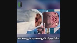 یکماه بعد از جراحی ترمیمی بینی با پوست ضخیم | دکتر باستانی نژاد