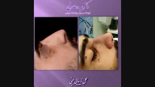 عمل زیبایی بینی توسط دکتر سید رضا رفیع | جراح پلاستیک