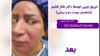 فیلم واقعی تزریق چربی