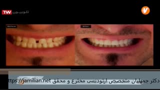 بهترین انتخاب برای درمان فاصله بین دندان ها / متخصص ارتودنسی / دکتر جمیلیان