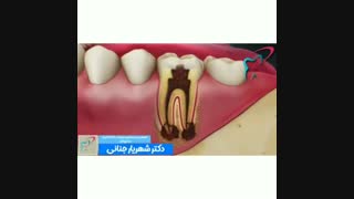 عوارض پوسیدگی دندان