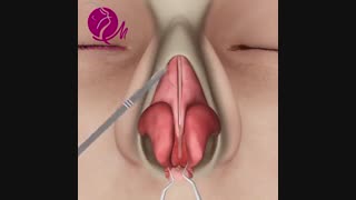 جراحى زیبایى بینى (تبریز)