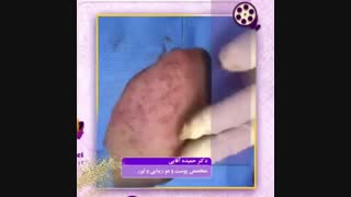 فیلم واقعی سابسیژن پوست پاکسازی پوست